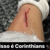 Adson exibe marcas da entrada sofrida na vitória do Corinthians contra o Athletico
