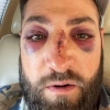Cenas fortes! Rebatedor da MLB publica imagem impressionante após bolada a 150km/h e fraturas no nariz