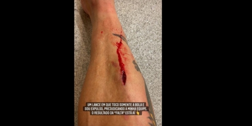 Imagem forte! Fagner mostra corte na perna após expulsão pelo Corinthians: 'Resultado da falta'