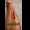 Imagem forte! Fagner mostra corte na perna após expulsão pelo Corinthians: ‘Resultado da falta’
